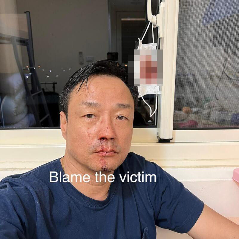 Vương Hỷ đăng thêm ảnh bị thương do test PCR sau khi bị dân mạng công kích.