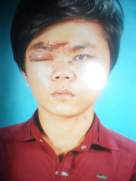 Một trong những thương tích của Hiền khi bị cha con ông Nọ hành hung
