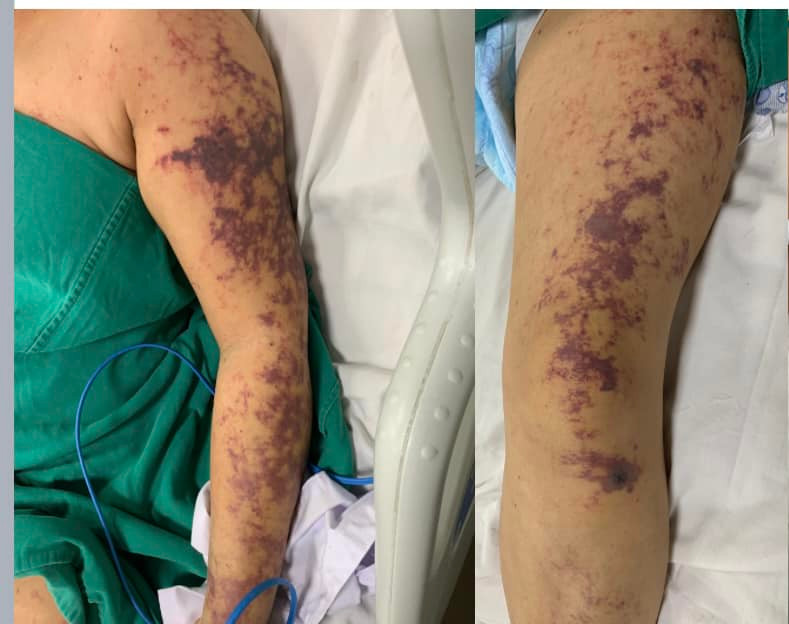 Ảnh minh họa bệnh liên cầu lợn.