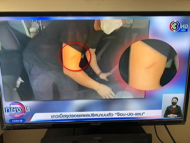 Vết thương dài trên tay của Por. - Ảnh: CH3 Vết thương dài trên tay của Por. - Ảnh: CH3