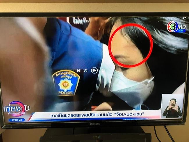 Vết xước trên trán... - Ảnh: CH3 Vết xước trên trán... - Ảnh: CH3