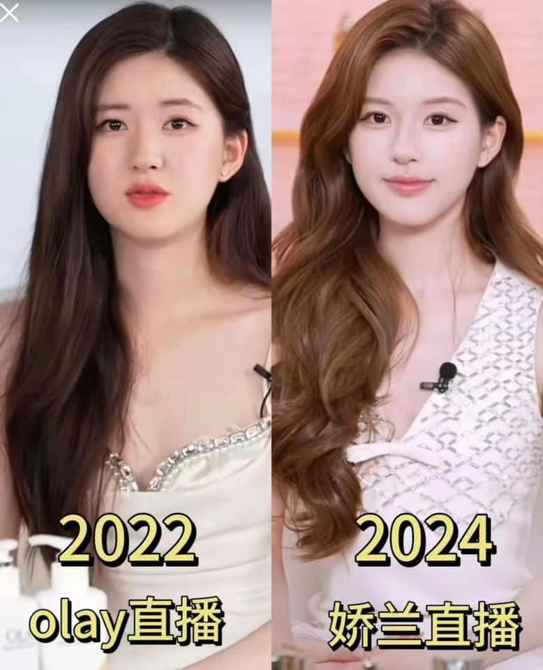 So sánh với hình ảnh khoảng 2 năm trước, vùng cằm của Triệu Lộ Tư ở thời điểm hiện tại V-line hơn, khuôn hàm cũng gọn hơn rất nhiều và đôi môi dày, rõ khóe cười hơn. So sánh với hình ảnh khoảng 2 năm trước, vùng cằm của Triệu Lộ Tư ở thời điểm hiện tại V-line hơn, khuôn hàm cũng gọn hơn rất nhiều và đôi môi dày, rõ khóe cười hơn.