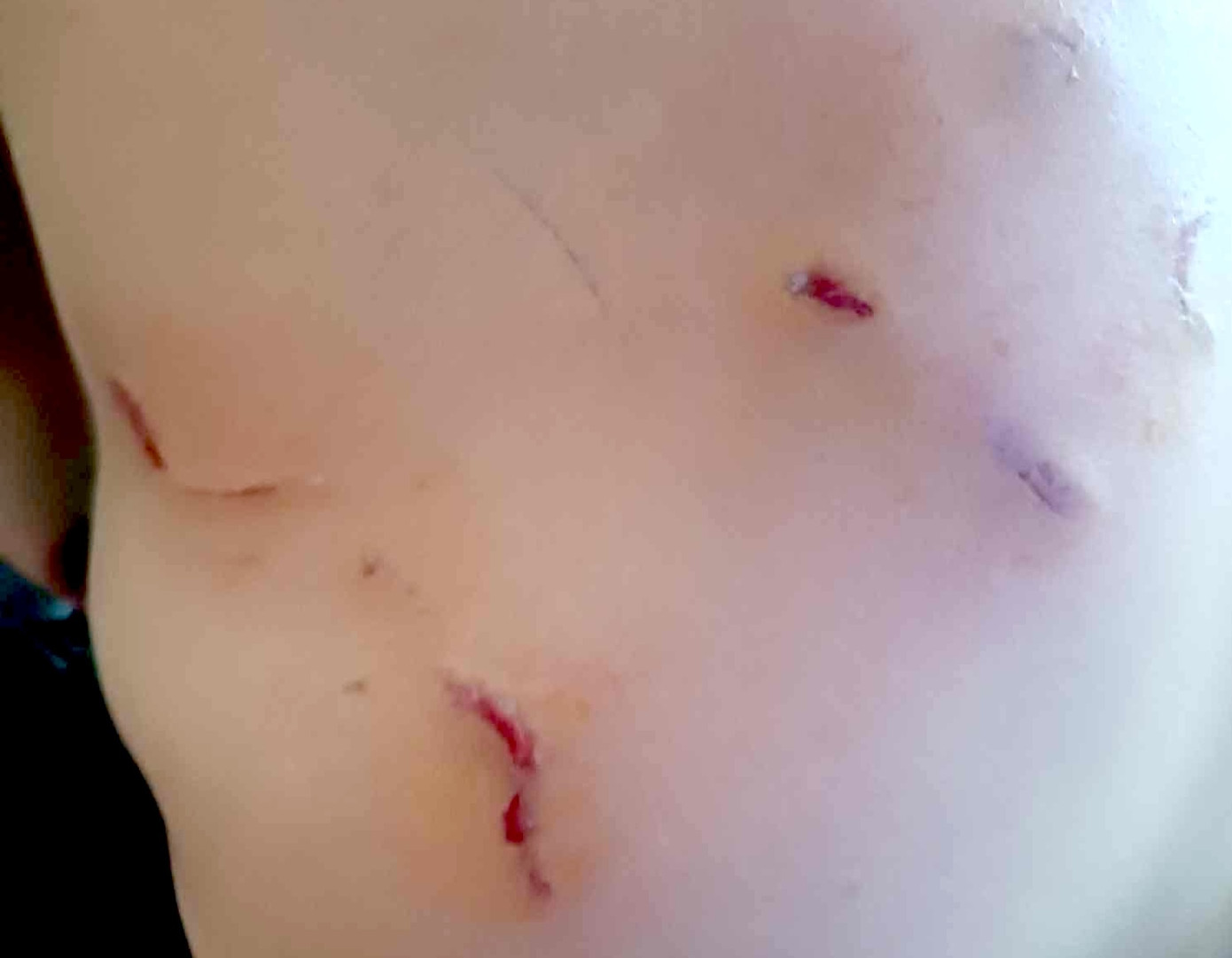 Lưng anh Thế bị nhiều vết xước sâu do cá thể voọc gây ra.