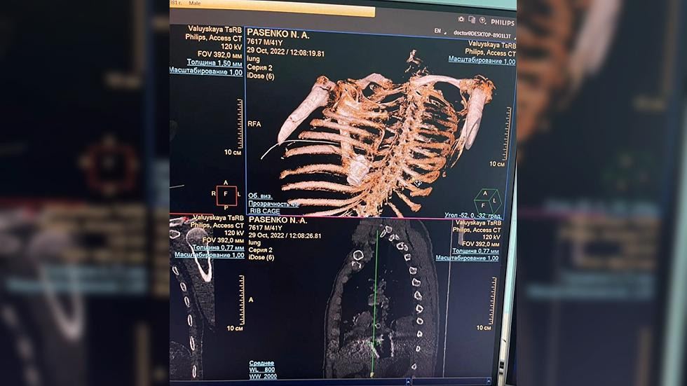 Vị trí viên đạn trong cơ thể Pasenko. Ảnh: RT Vị trí viên đạn trong cơ thể Pasenko. Ảnh: RT