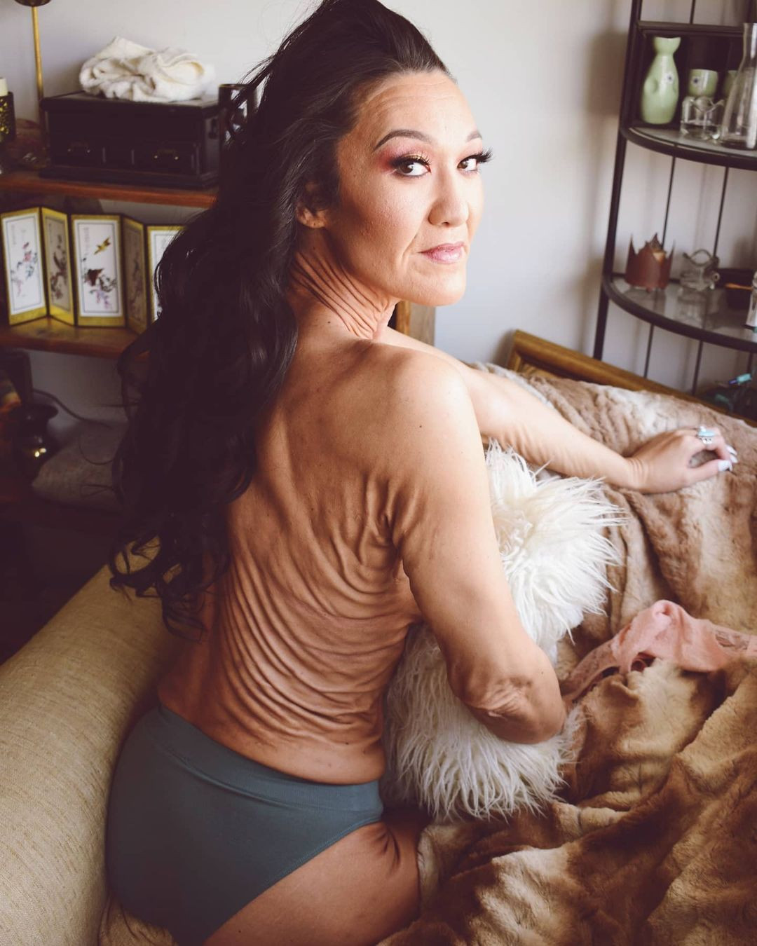 Sara mắc chứng rối loạn hiếm gặp gọi là Hội chứng Ehlers-Danlos, ảnh hưởng đến các mô liên kết ở da, khớp và mạch máu. Trong trường hợp của Sara, nó ức chế quá trình sản xuất collagen trong cơ thể, khiến da cô bị nhăn nheo như người già dù mới 32 tuổi.