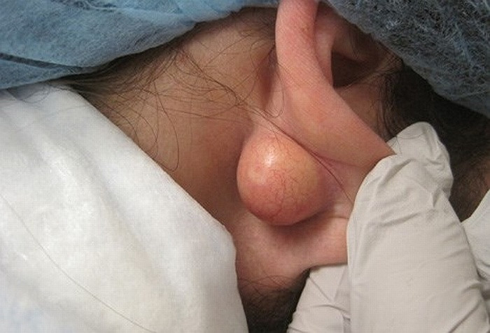  U nang (EIC), còn được gọi là u nang bã nhờn và nang biểu bì, là dạng thường gặp nhất của da. Nó có kích thước từ vài mm đến vài cm và có nguồn gốc từ phễu nang