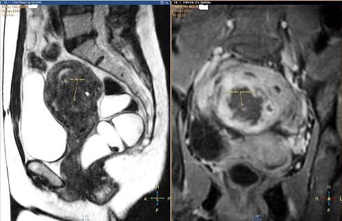 Ảnh MRI khốilạc nội mạc tử cung của chị Kim. nhieu-phu-nu-bi-lac-noi-mac-tu-cung-ma-khong-biet
