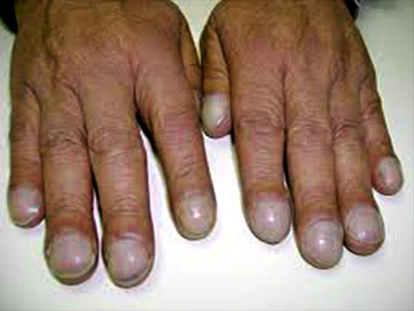 mong-tay-canh-bao-benh-tat-1