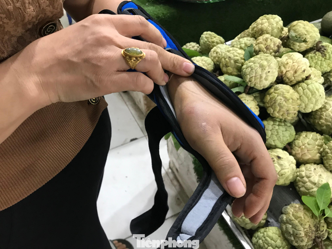 Người phụ nữ bị chiếc cờ lê rơi trúng tay nhiều khả năng phải phẫu thuật. Ảnh: Trường Phong