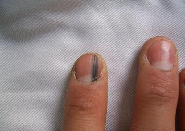 Phát hiện dấu hiệu ung thư tiềm ẩn qua móng tay, tóc, răng... ảnh 2