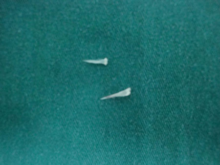 2 mẩu xương cá găm trong họng bé B.N