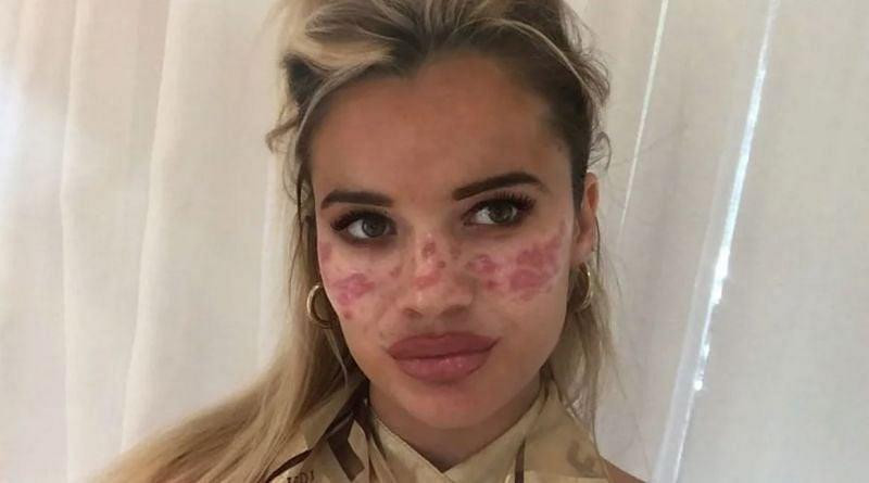 Làn da của Tilly Whitfield bị ảnh hưởng nghiêm trọng Làn da của Tilly Whitfield bị ảnh hưởng nghiêm trọng