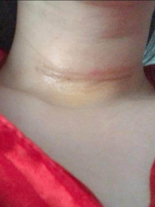 Hình ảnh sau khi phẫu thuật được cô chia sẻ Hình ảnh sau khi phẫu thuật được cô chia sẻ