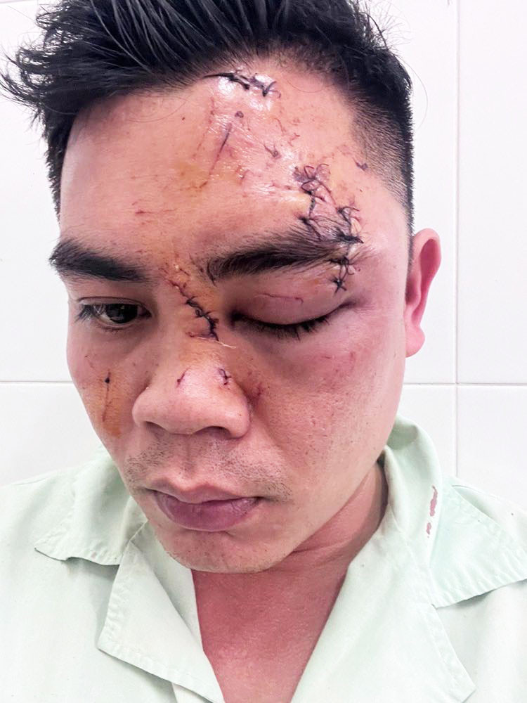 Thương tích trên mặt của anh T.