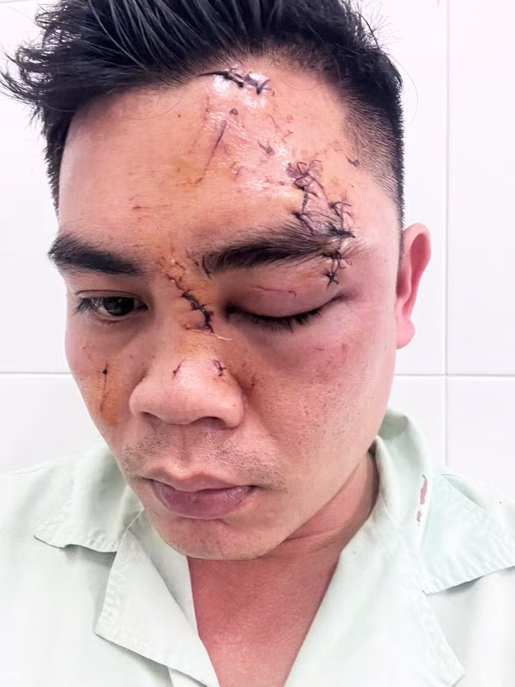 Thương tích trên mặt của anh T.