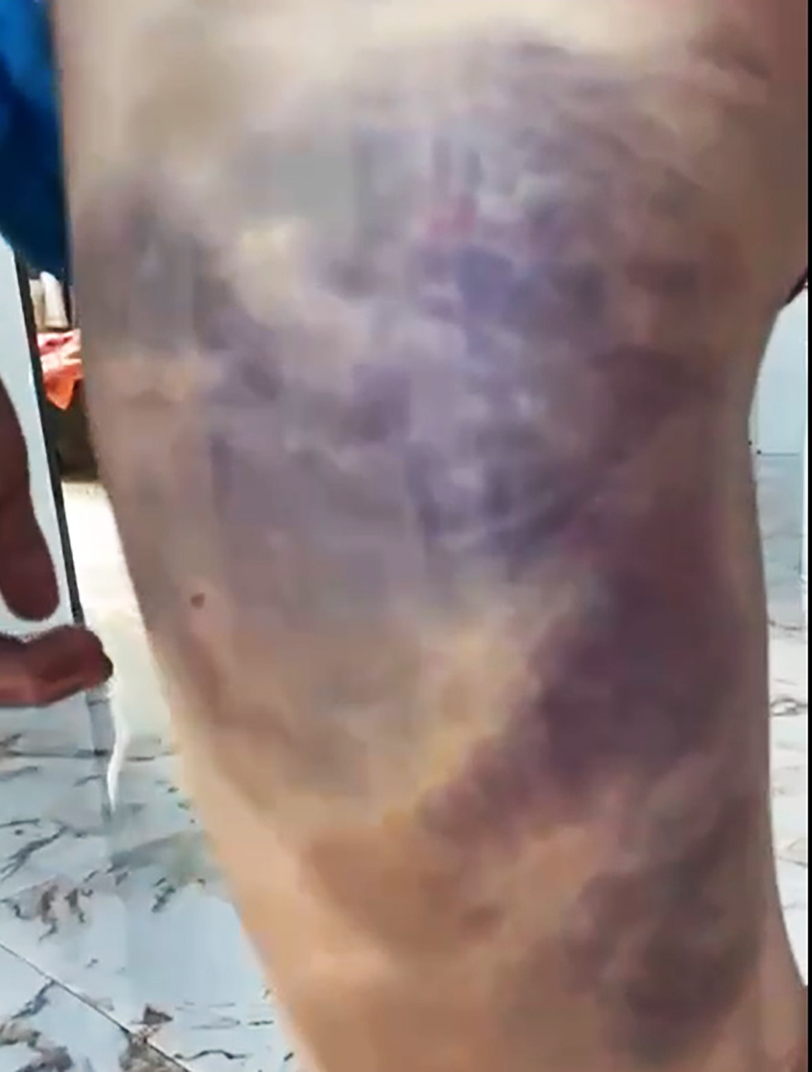 Những vết bầm tím trên cơ thể của H.