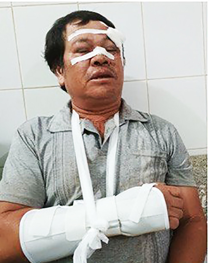 Ông Tùng bị gãy tay cùng nhiều vết thương trên mặt