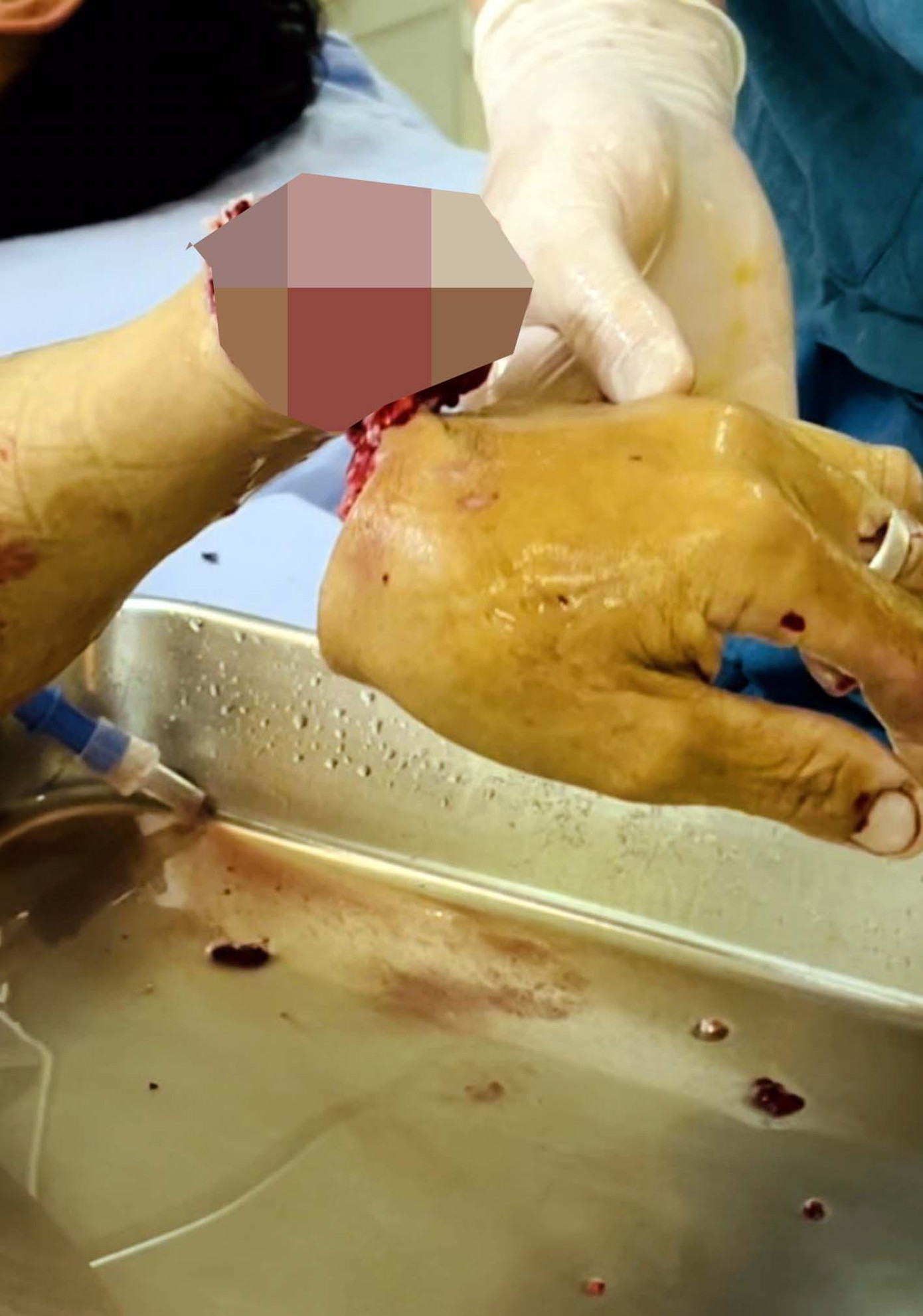 Bàn tay bị đứt lìa