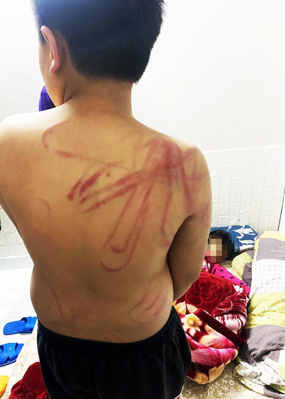 Vết thương trên người cháu bé Vết thương trên người cháu bé