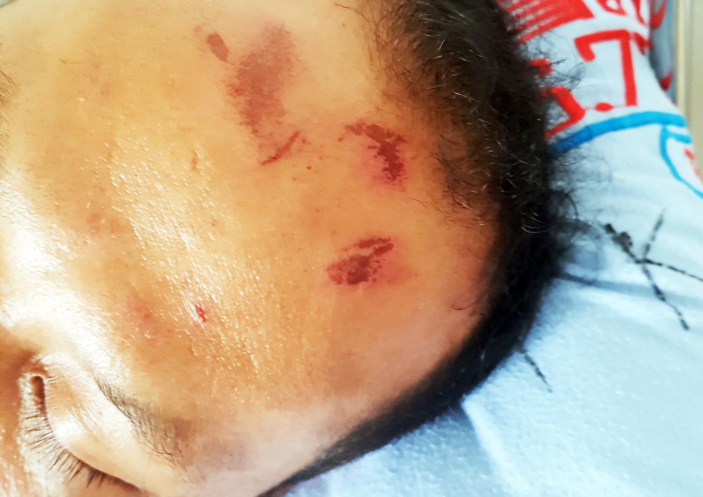 Một số vết thương trên trán nạn nhân Một số vết thương trên trán nạn nhân