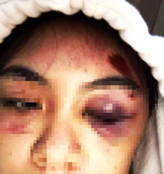 Thương tích trên mặt của nữ sinh L.T.M.T Thương tích trên mặt của nữ sinh L.T.M.T