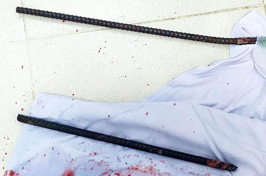 2 thanh sắt lấy ra từ người bệnh nhân 2 thanh sắt lấy ra từ người bệnh nhân