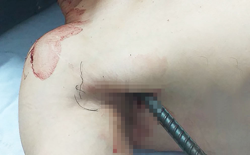 Nam thanh niên bị cây sắt đâm xuyên qua người Nam thanh niên bị cây sắt đâm xuyên qua người