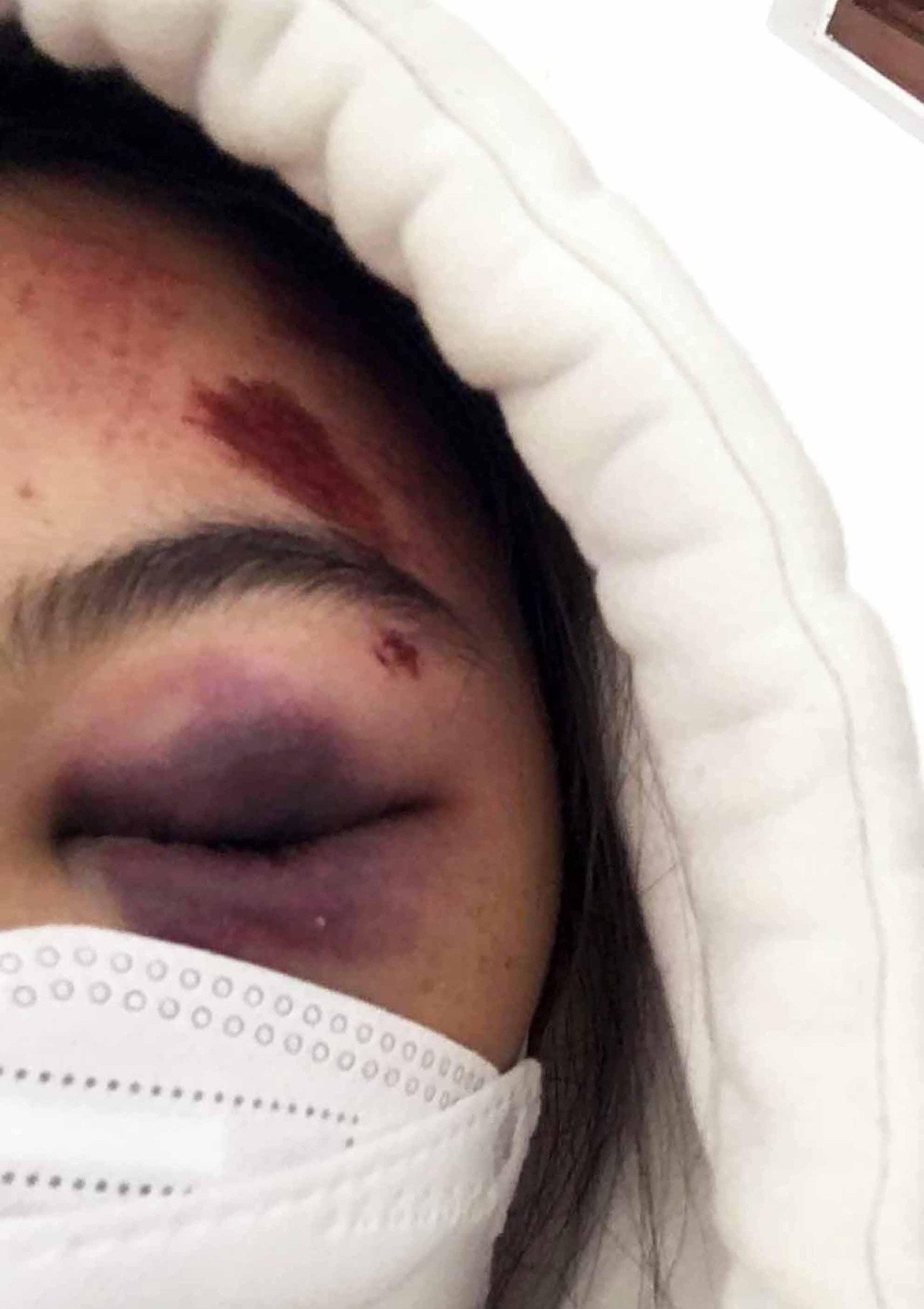 Một số vết thương trên mặt em T.