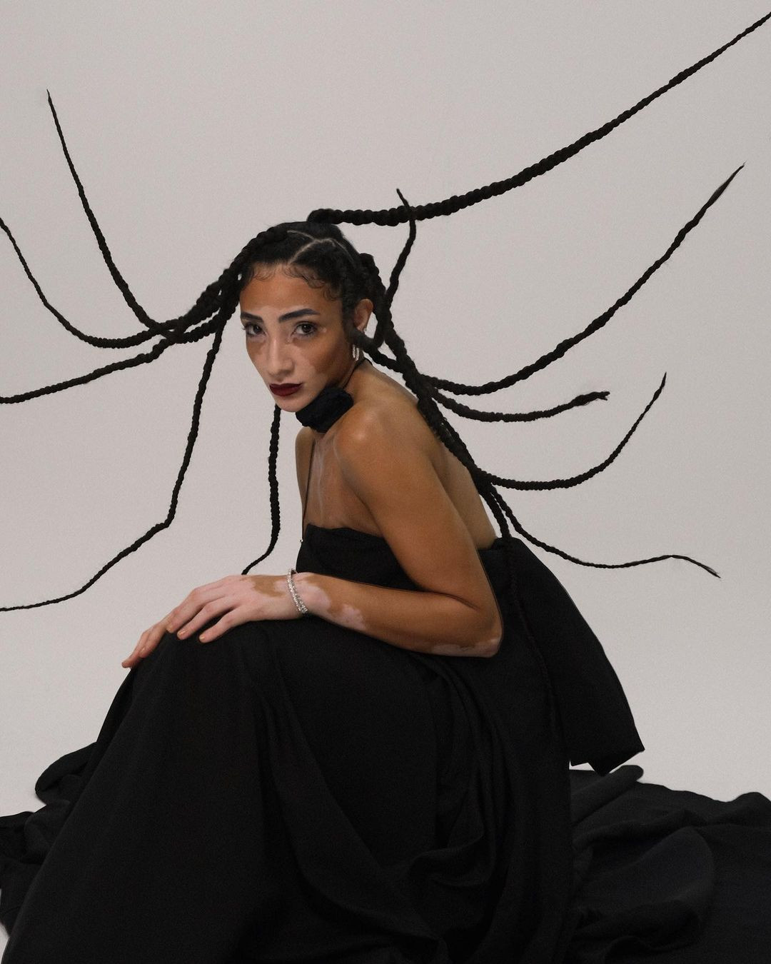 Logina Salah được chẩn đoán mắc bệnh bạch biến rối loạn da khi còn trẻ.