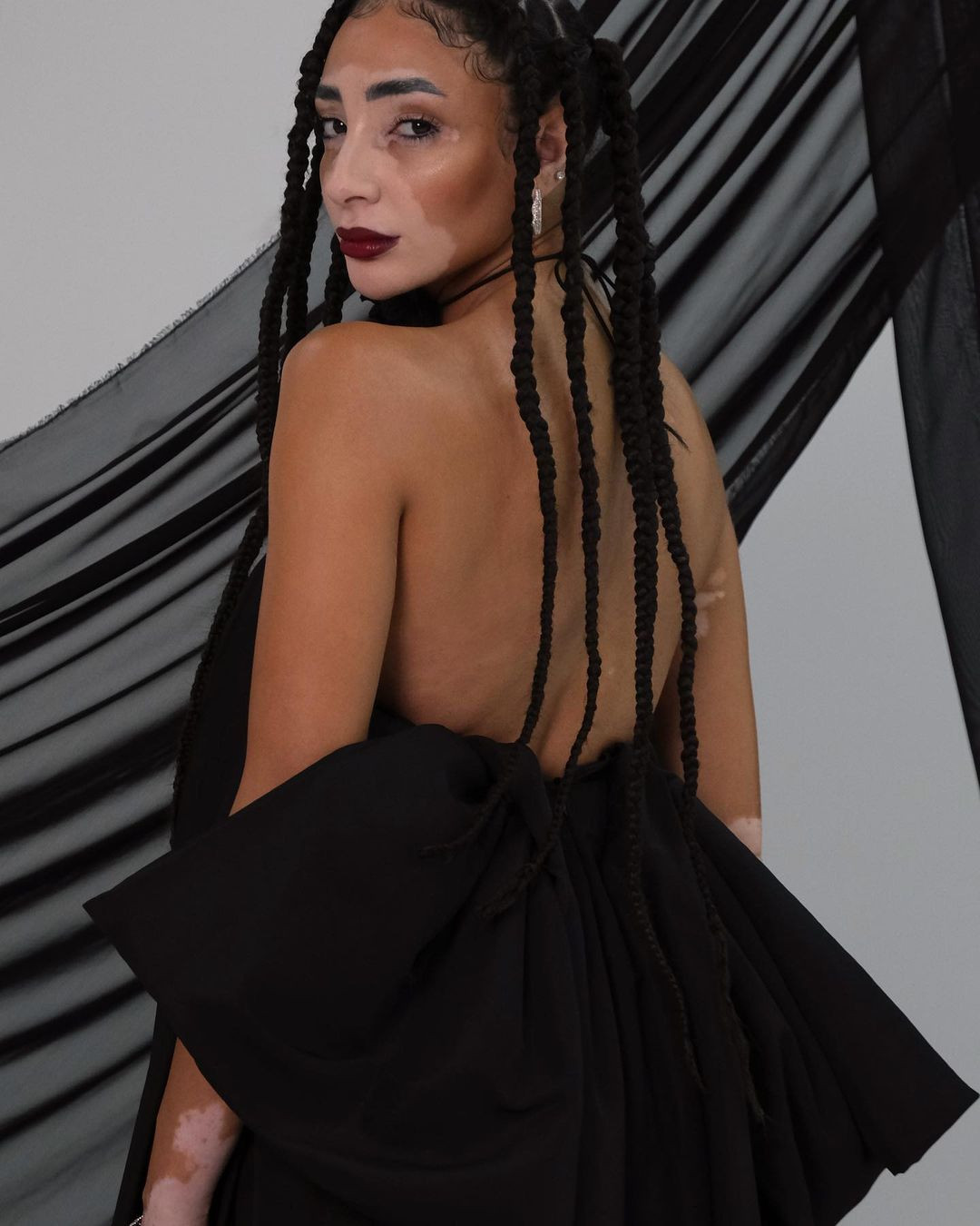 Logina Salah được chẩn đoán mắc bệnh bạch biến rối loạn da khi còn trẻ.