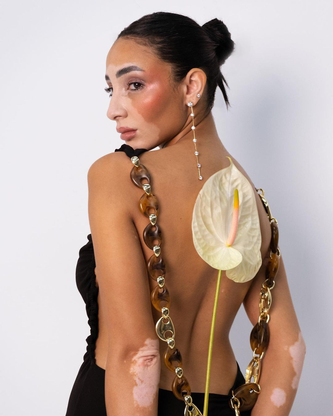 Logina Salah được chẩn đoán mắc bệnh bạch biến rối loạn da khi còn trẻ.