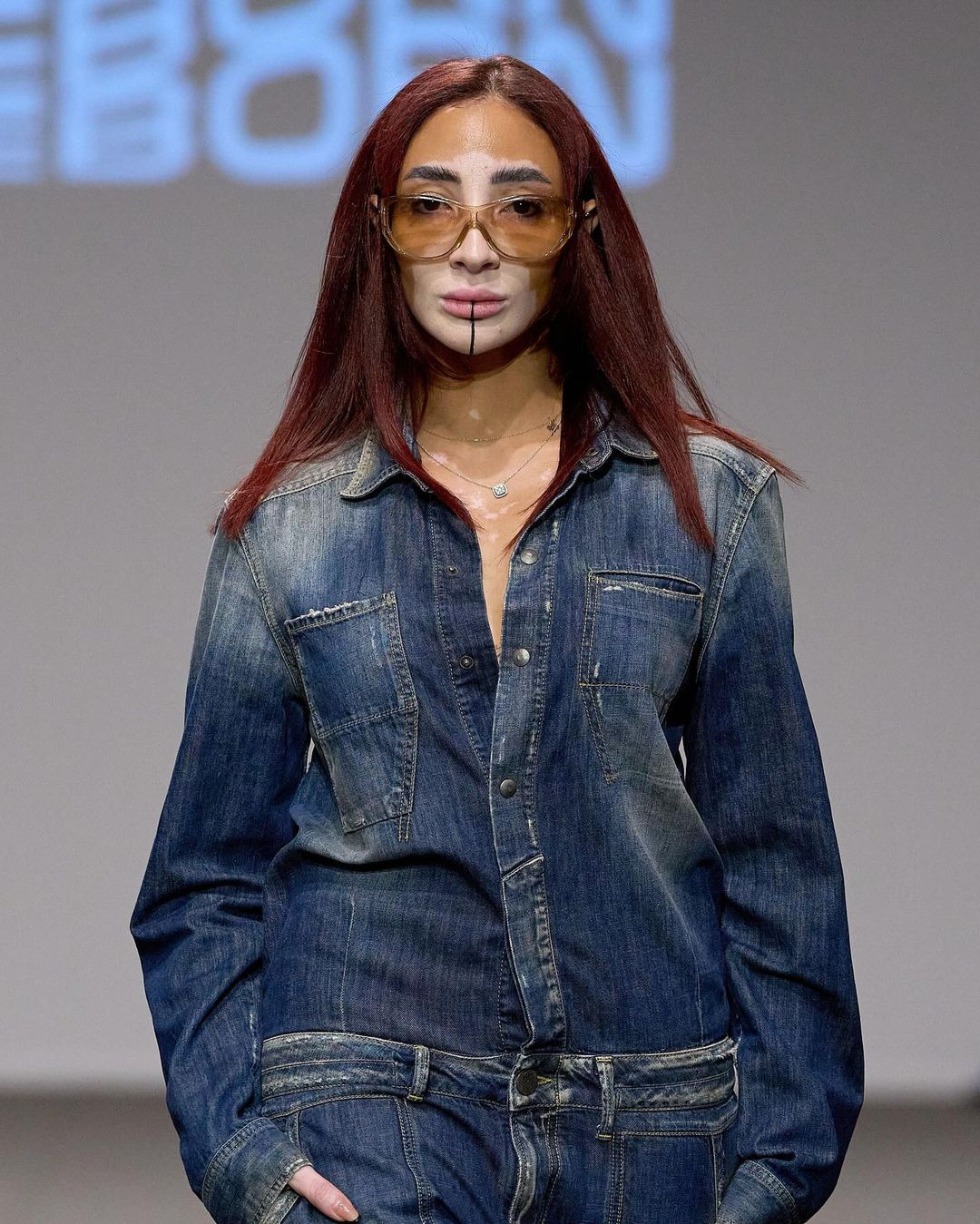 Vượt qua mặc cảm, Logina Salah theo đuổi sự nghiệp người mẫu và là một trong những người mẫu bạch biến nổi tiếng trên thế giới.