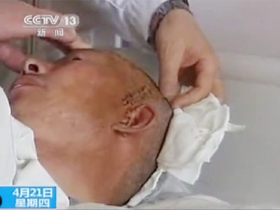 Nạn nhân đã may mắn sống sót sau 23 năm bị đạn găm trong đầu