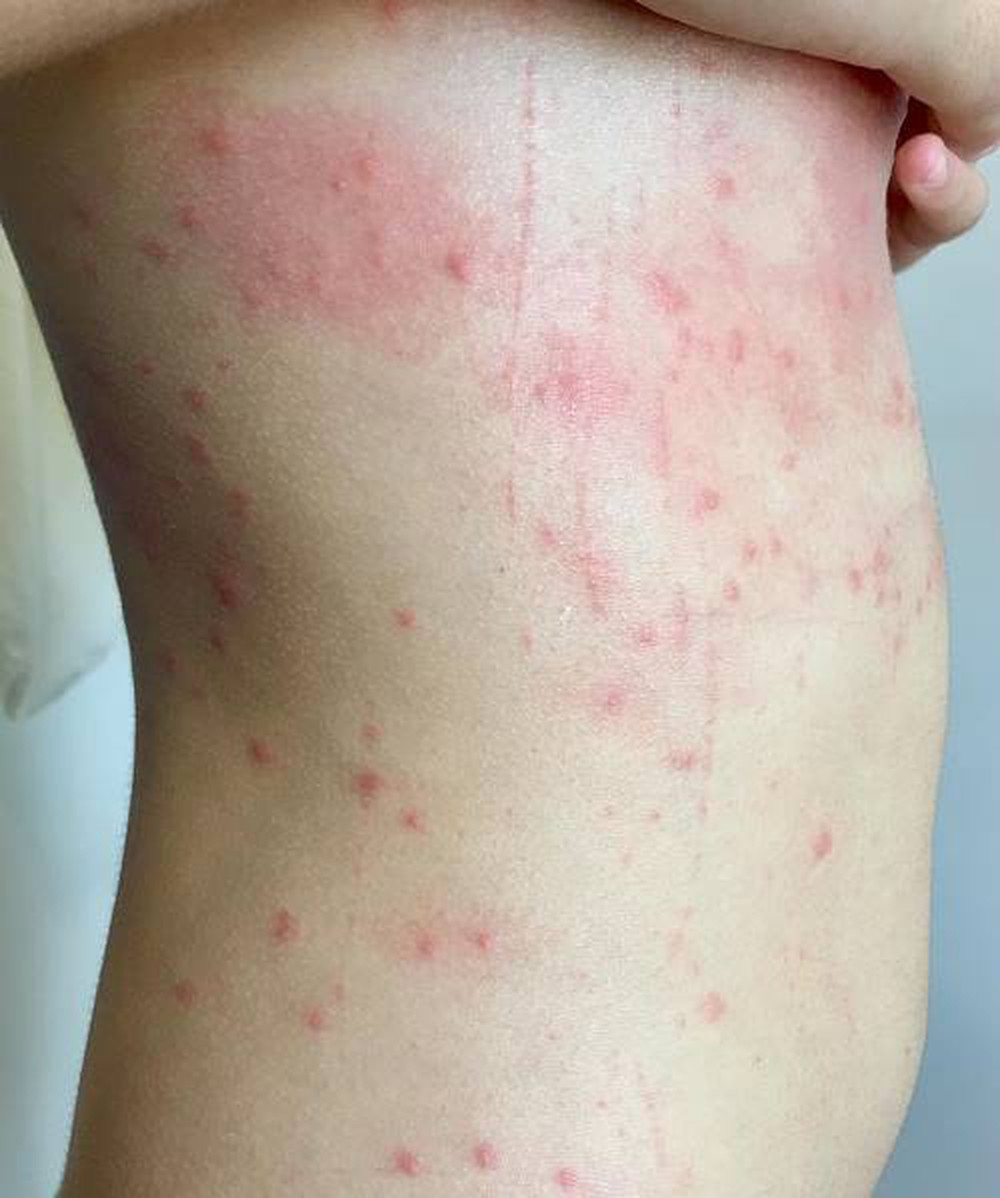 Triệu chứng ngứa, nổi mẩn dưới da lâu ngày có khả năng là do giun sán ký sinh trong cơ thể gây ra.