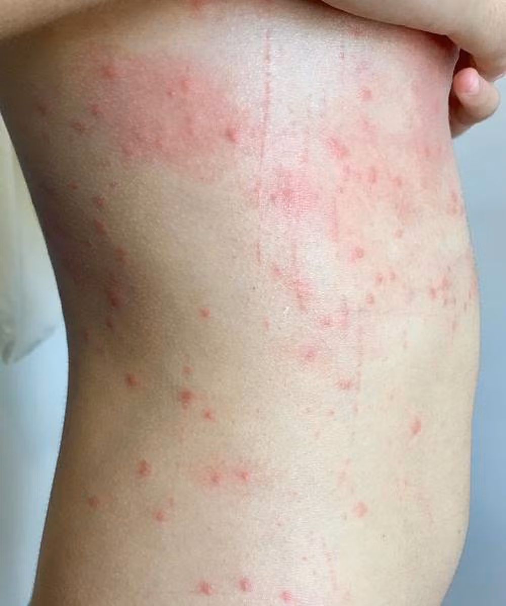 Triệu chứng ngứa, nổi mẩn dưới da lâu ngày có khả năng là do giun sán ký sinh trong cơ thể gây ra.