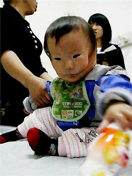 Cậu bé 14 tháng tuổi người Trung Quốc tên là Khang Khang mang dị tật hàm mặt. Nhìn bên ngoài, trông mặt bé như có vết nứt kéo dài từ miệng lên tới hai tai