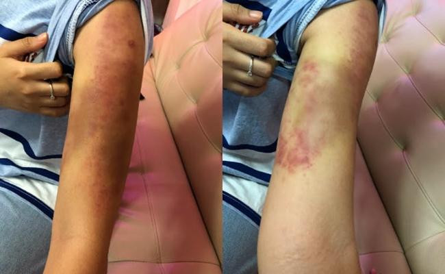 Cánh tay bầm đen vì đốt mỡ của Phương Mỹ Chi. - Ảnh: NVCC. Cánh tay bầm đen vì đốt mỡ của Phương Mỹ Chi. - Ảnh: NVCC.