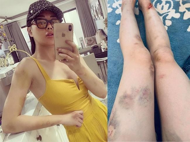 Những hình ảnh tay chân chằng chịt vết thương vì chương trình "Mỹ Nhân Hành Động" của Phương Oanh khiến người hâm mộ vừa khâm phục vừa đau lòng.