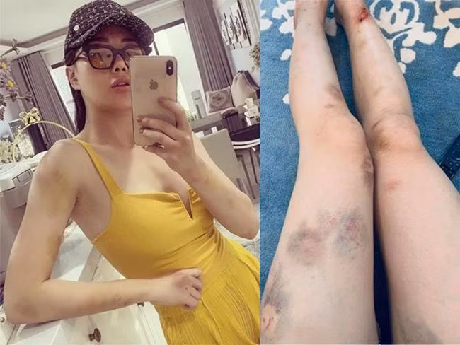 Những hình ảnh tay chân chằng chịt vết thương vì chương trình "Mỹ Nhân Hành Động" của Phương Oanh khiến người hâm mộ vừa khâm phục vừa đau lòng. Những hình ảnh tay chân chằng chịt vết thương vì chương trình "Mỹ Nhân Hành Động" của Phương Oanh khiến người hâm mộ vừa khâm phục vừa đau lòng.
