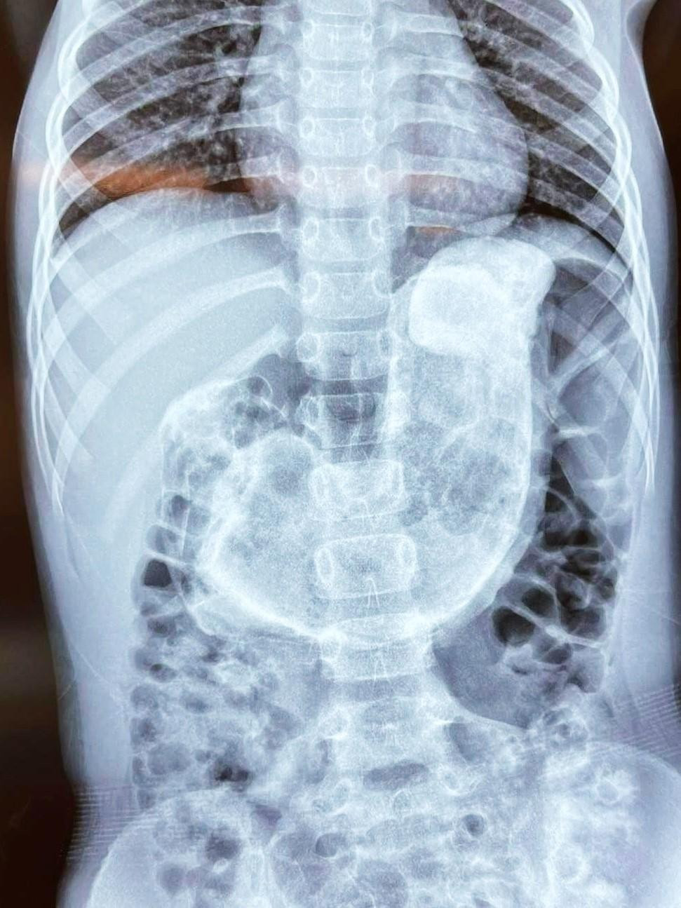 Búi tóc lớn (vùng màu trắng ở giữa) gần như chiếm trọn dạ dày của bệnh nhi Búi tóc lớn (vùng màu trắng ở giữa) gần như chiếm trọn dạ dày của bệnh nhi