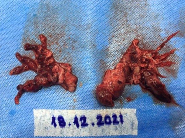 Huyết khối được bác sĩ phẫu thuật, lấy ra từ 2 nhánh động mạch phổi của người bệnh Huyết khối được bác sĩ phẫu thuật, lấy ra từ 2 nhánh động mạch phổi của người bệnh