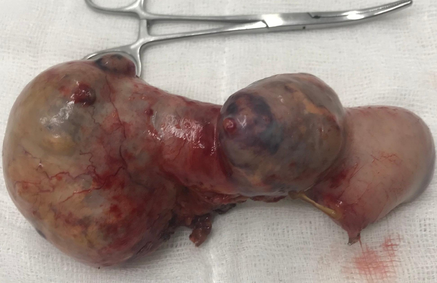 Khối u phình lớn dọa vỡ đã được các bác sĩ cắt thành công ra khỏi cơ thể người bệnh Khối u phình lớn dọa vỡ đã được các bác sĩ cắt thành công ra khỏi cơ thể người bệnh