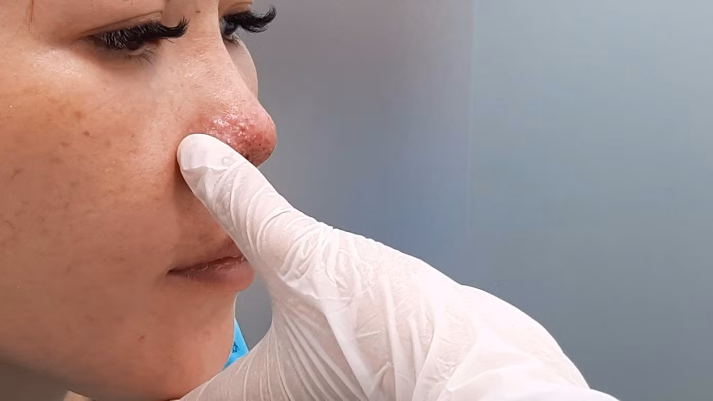 Vùng mũi bệnh nhân đã bị biến dạng, hoại tử da sau khi tiêm filler