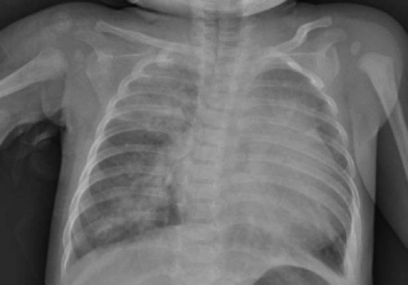 X-quang ngực cho thấy hình ảnh tổn thương thâm nhiễm phổi nặng lan tỏa 2 phế trường, bóng tim to (ảnh: BVCC) X-quang ngực cho thấy hình ảnh tổn thương thâm nhiễm phổi nặng lan tỏa 2 phế trường, bóng tim to (ảnh: BVCC)