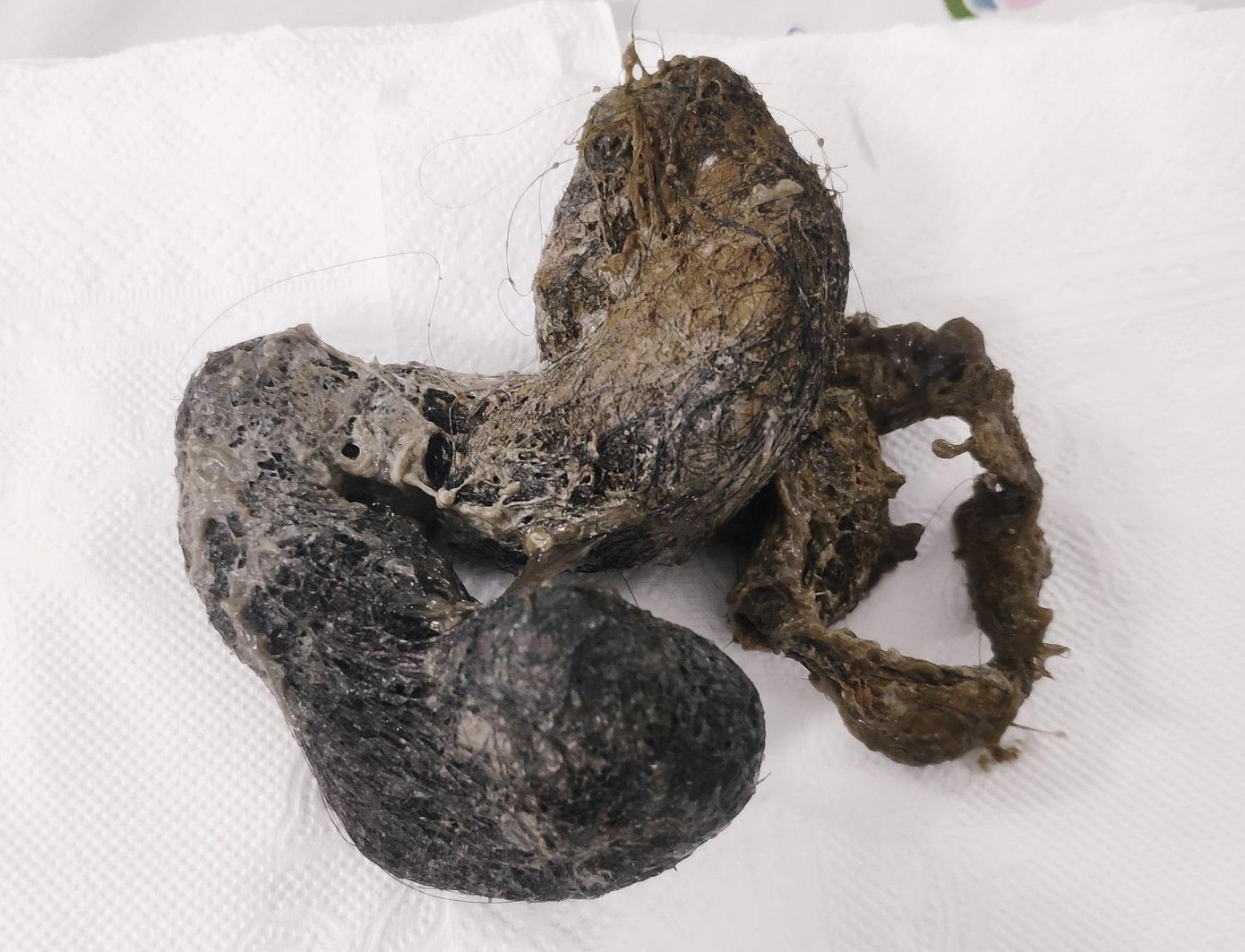 Búi tóc khổng lồ được nhân viên y tế lấy ra từ đường ruột của bệnh nhi