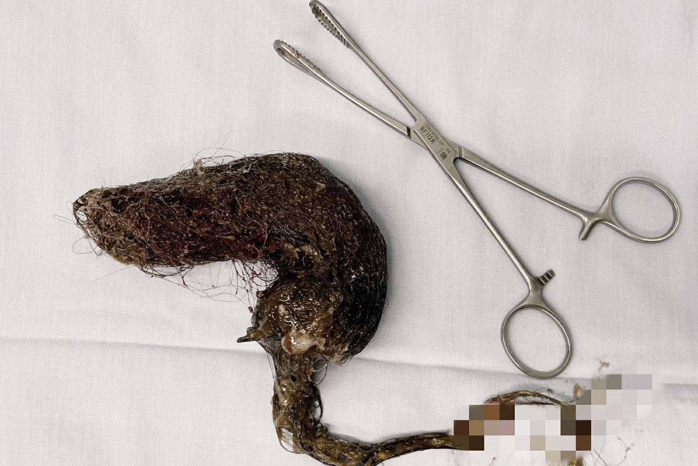 Các bác sĩ đã lấy thành công búi tóc khoảng 1kg từ đường tiêu hóa của bệnh nhân ra ngoài Các bác sĩ đã lấy thành công búi tóc khoảng 1kg từ đường tiêu hóa của bệnh nhân ra ngoài