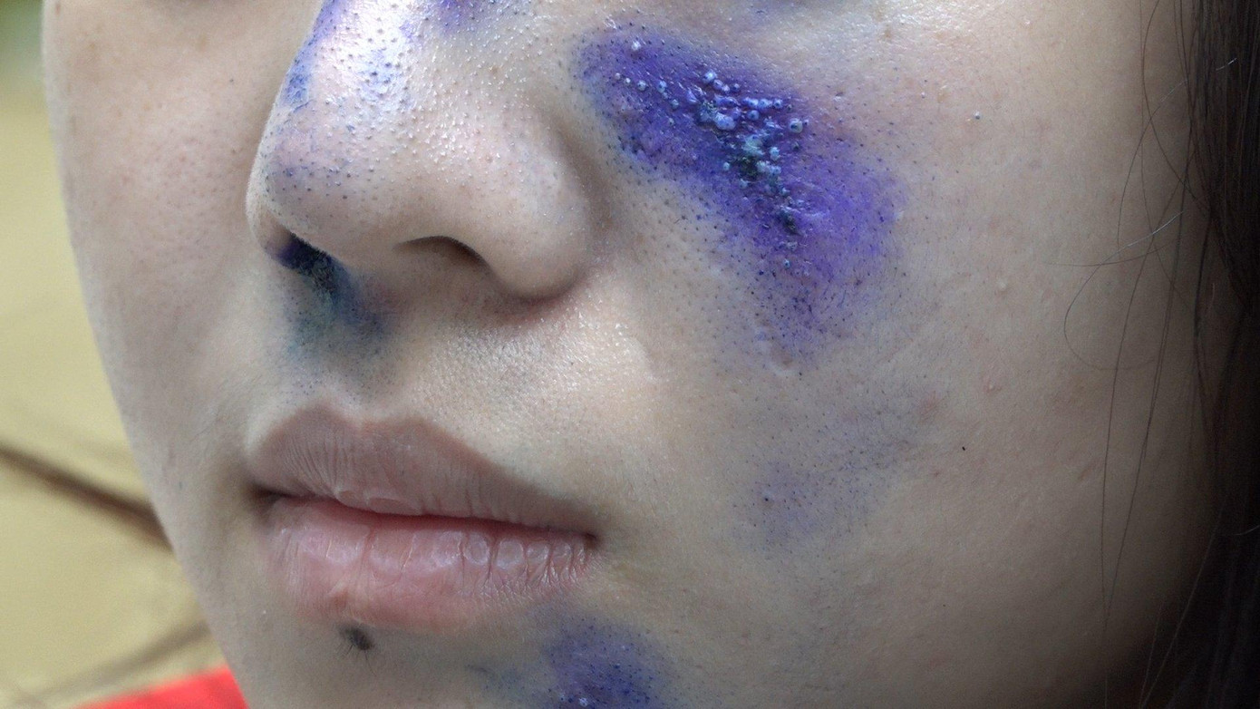 Nữ bệnh nhân bị độc tố của kiến ba khoang gây tổn thương da mặt đến Bệnh viện Da Liễu thăm khám Nữ bệnh nhân bị độc tố của kiến ba khoang gây tổn thương da mặt đến Bệnh viện Da Liễu thăm khám