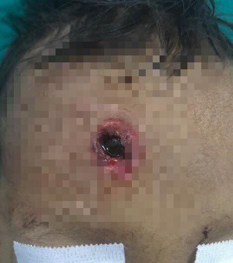 Nghịch súng tự chế của cậu, bé trai bị đạn bay xuyên não ảnh 2