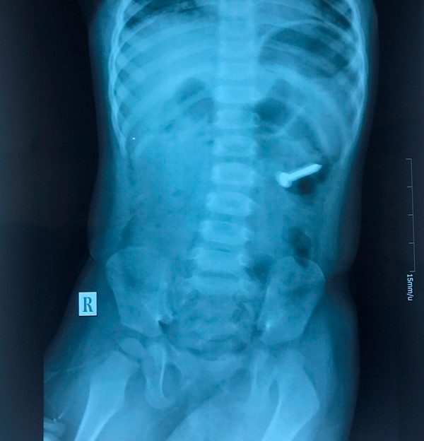 Gắp thành công đinh xoắn ốc ra khỏi dạ dày bé gái 2 tuổi ảnh 1