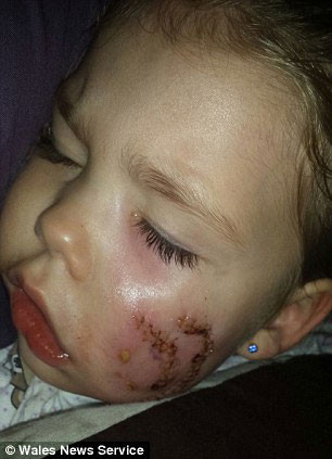 Cô bé Maddison với gương mặt bị thương nặng. Cô bé Maddison với gương mặt bị thương nặng